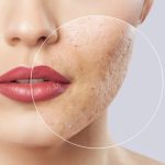 Kozmetikai és orvostechnikai kezelések Dunakeszin: férfi kozmetika, lézeres szőrtelenítés, gyantázás, wax, carbon peeling, végleges szőrtelenítés, fülbelövés, intimgyanta, mikrotűs mezoterápia, pigment halványítás, aknés bőr, fibróma eltávolítás, hydrabeauty, szempilla dauer lifting, mikrodermabrázió, hydra face, hydra facial, rosacea hajszálér kezelés, medical piercing, fülakupunktúra, tetoválás eltávolítás, savas hámlasztás. Göd, Fót, Budakalász, Vác, Veresegyház, Újpest környékén