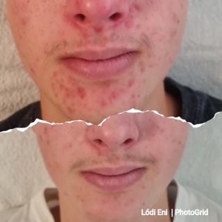 2 alkalom carbon peeling kezelés