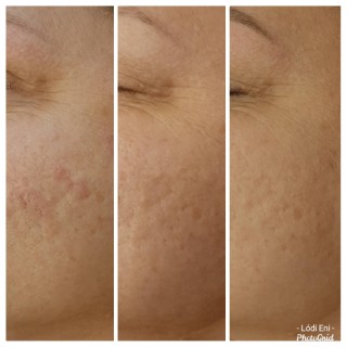dermapen