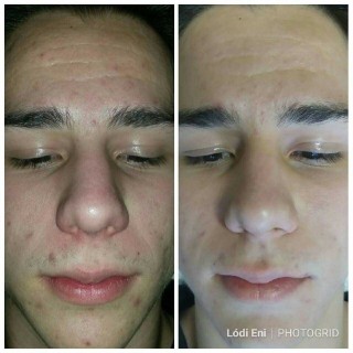 dermaroller2