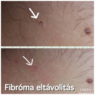 Fibróma eltávolítás Dunakeszi kozmetika