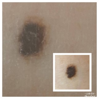 Melanoma, szakértő bőrápolás, bőrdiagnosztika Dunakeszin